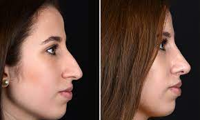 Nasenkorrektur Nasen Op Rhinoplastik In Wien Dr Thomas Fasching