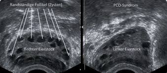 Pcos stands for polycystic ovary syndrome. Ultraschallbild Pco Syndrom Perlenkette Any Working Mom