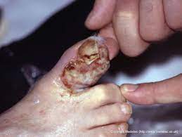 Infected Wounds, Causes, Symptoms And Treatment | Woundsource
