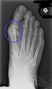 Image result for Hallux Varus