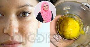 Cara alami menghilangkan bekas jerawat. Masker Magik Hilangkan Jeragat Degil Dari Bahan Dapur Yang Murah Syaratnya Jangan Pakai Lebih 15 Minit Hijabista