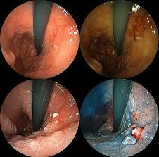 Some common signs of metastatic cancer include: Stomach Cancer Wikiwand