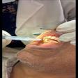 Root canal treatment product image