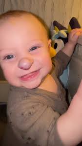 Hemangioma Em Bebê No Pescoço Grande