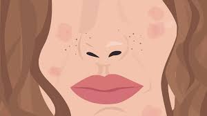 Eczema—also called atopic dermatitis—is a skin condition characterized by red, flaky, itchy skin. How To Treat Eczema Especially When It S Severe Glamour