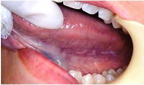 Image result for lichen planus on tongue)