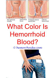 Are Internal Hemorrhoids Hereditary Do Hemorrhoids Cause High Blood Pressure How Do Internal Hemorrhoids Start Can Driving C Internal Hemorrhoids Hemor