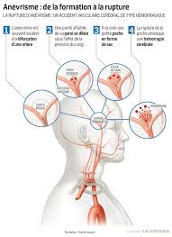 Afla de pe doc.ro totul despre anevrismul cerebral: Un Gene Implique Dans Les Anevrismes Cerebraux A Ete Identifie