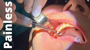 I do not want to be numb any more i love you so much and wished i had kissed you that night. Tooth Extraction In Under 30 Seconds Pain Free Palatal Anesthesia Youtube