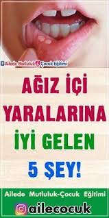 agiz ici yaralarina iyi gelen 5 sey evde fitness saglik saglik ipuclari