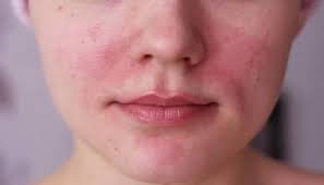 acne rosacea symptoms causes and