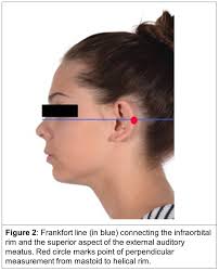 Otoplasty: Surgical Technique to Correct Prominent Ears