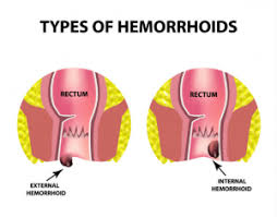 Image result for Hemorrhoid