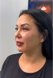 Rinoplastia y Estetica Facial: Lo que Debes Saber