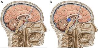 Dorsum Sellae as Key Landmark in ETV With Disminished Prepontine Cistern:  Technical Note and Case Series