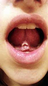 Piercing Fail Tongue Web Fail Tongue Web Piercing Web Piercing Piercing