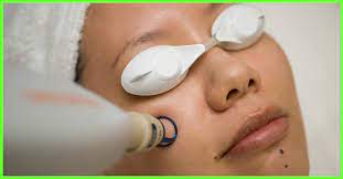 Direct a beam of light at your skin's surface, areas of higher melanin pigment (dark hairs) will absorb the light energy, which converts to heat energy and burns the hair, damaging the follicle so that its hair growth is impeded. What Are The Side Effects Of Laser Hair Removal