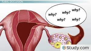 Female Sterilization Procedures Tubal Ligation And Tubal Occlusion Video Lesson Transcript Study Com