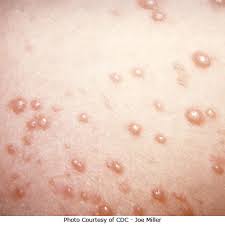 The best way to prevent chickenpox is to be vaccinated. Chickenpox Gambar Gejala Rawatan Dan Pencegahan