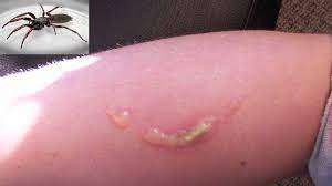 Most bites may not even be noticed. Spider Bites Identify What Bit You And Get Proper Help