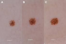 Image result for Spitz Nevus