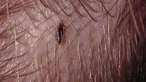 كيف أعرف أن شعري فيه قمل Head Louse Home Remedies Louse