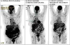Maybe you would like to learn more about one of these? Frontiers Lurbinectedin In Refractory Diffuse Malignant Peritoneal Mesothelioma Report Of Two Cases Oncology