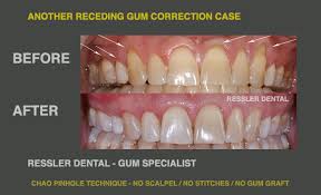 Fix Receding Gums Graft Repair Boynton Beach Gum Specialist Periodontist Delray Beach Ressler Dental