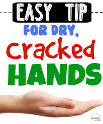 Dry Cracked Hands This Winter I Finally Found A Solution Dry Cracked Hands Cracked Hands Dry Skin On Face