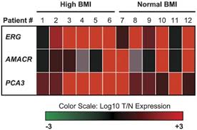 Curable early stage prostate cancer usually does not cause pain, says sean cavanaugh, md, chief of radiation oncology, cancer treatment centers of. Prostate Cancer Gene Expression Signature Of Patients With High Body Mass Index Prostate Cancer And Prostatic Diseases