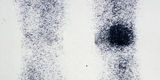 Les patients se plaignent de douleurs localisées dans la plante du pied ou le talon, au niveau de l'insertion du calcanéus. Algoneurodystrophie Les Patients Se Mobilisent Faire Face Toute L Actualite Du Handicap