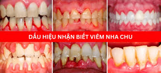 Dấu hiệu nhận biết viêm nha chu 