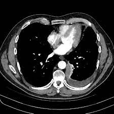 Review of radiologic studies focused on local invasion of three separate regions: Mesothelioma Radiology Case Radiopaedia Org