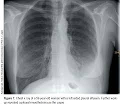 Treatment of pleural effusion is based on the underlying condition and whether the effusion is causing severe respiratory symptoms, such as shortness of. Artikel 207601
