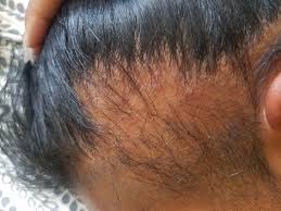 Hair loss and shedding are caused by dht  dihydrotestosterone caffeine blocks dht, helping to reduce shedding and stimulating hair growth; 16 Things For Anyone Whose Hair Is Always Everywhere
