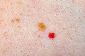 They are tiny, flat, red or purple spots in the skin, but they are different than the tiny, flat, red spots or birthmarks (hemangiomas) that are present all the time. Red Spots On Skin Causes Diagnosis And Treatments