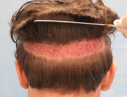 This can worry those patients that are slower to grow, but they, too, should expect to see their new grafts grown through by the 12 month stage. Long Hair Robotic Fue Artas Hair Bernstein Medical