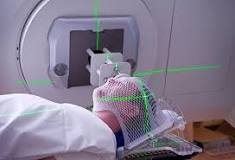 Image result for what is stereotactic radiation treatment