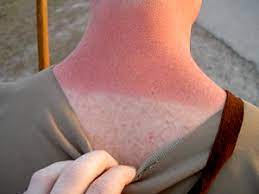 Sonnenbrand Klexikon Das Kinderlexikon