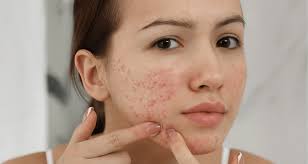 Mụn bên má: Nguycách chăm sóc mụn mủ da khô ở má ên nhân và cách điều trị mụn ở má