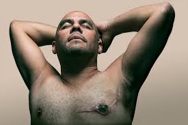 Types vary based on the location of cancer cells and what they look like. Male Breast Cancer In Progress Brent Stirton