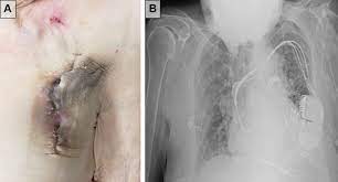 Pacemaker vs implantable cardioverter defibrillator. Double Trouble Management Of Implantable Cardioverter Defibrillator Infection In The Setting Of Severe Aortic Stenosis Heartrhythm Case Reports