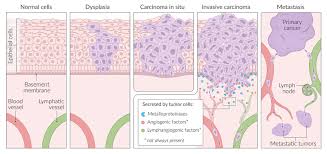 Squamous cell carcinoma, follicular dendritic cell tumor, angiosarcoma, seminoma, serous carcinoma. General Oncology Knowledge Amboss