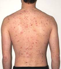 The signs and symptoms include a sore throat, fever, headaches, swollen lymph nodes, and a characteristic rash. Scarlattina Cosa Fare Per Il Prurito