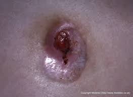 Showers are better than baths because the wound does not soak in the water. Wound Care Getting To The Depth Of The Tissue Nursece Com
