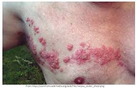 Image result for herpes zoster