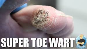 We did not find results for: Extra Large Toe Wart Removal Youtube