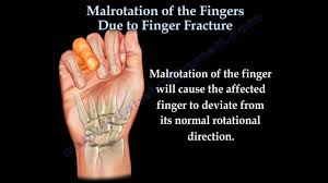 The customer fingered the sweater. Finger Fractures Malrotation Of The Fingers Everything You Need To Know Dr Nabil Ebraheim Youtube