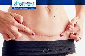 Cesarean Section Scar C Section Scar Treatment C Section Scar Itching