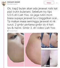 Melakukan usaha untuk menghilangkan jerawat tidak akan berhasil jika anda tidak rajin membersihkan wajah. Gadis Ini Dedah Cara Hilangkan Jerawat Dengan Cepat Perkongsian Youtuber Korea Popular Liah Soo Hijabista